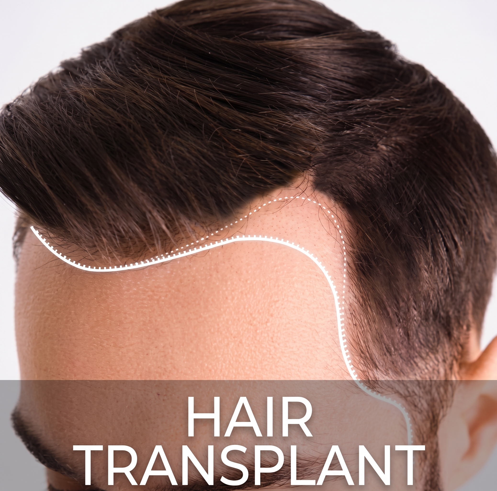 High Quality Hair Transplantation Surgery Coordinated by Monica Clinics